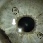 Rakovina oka – příznaky, příčiny, diagnostika a léčba