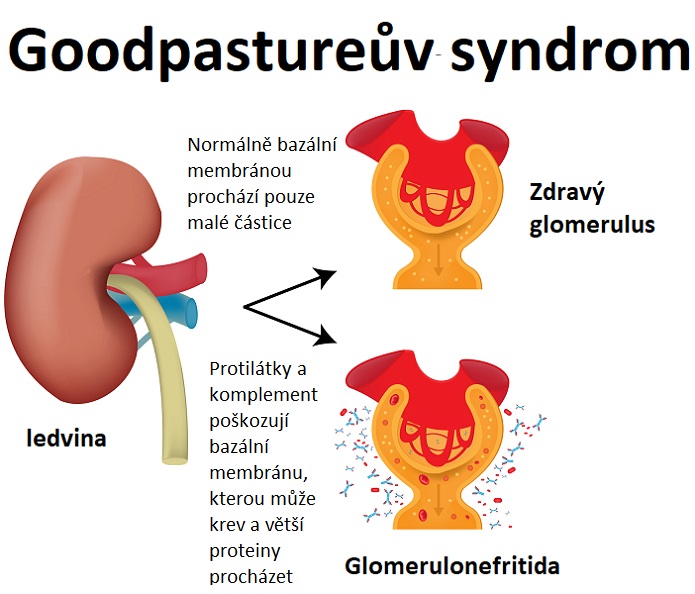 Goodpastureův syndrom - ilustrace