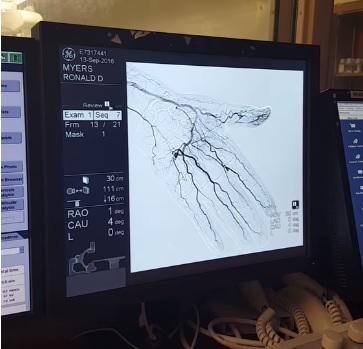 Takto může vypadat arteriogram (angiogram)