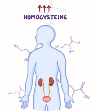 Příběh pacientky s homocystinurií