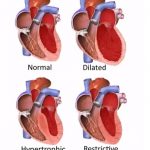 Kardiomyopatie (onemocnění srdečního svalu) – příznaky, příčiny a léčba