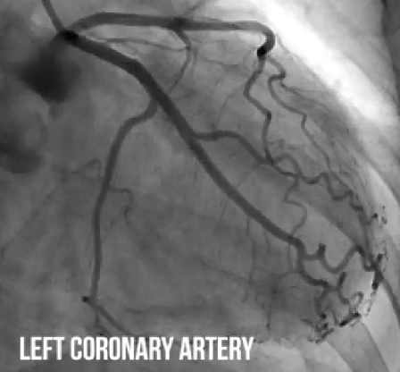 Levá koronární tepna - zobrazení