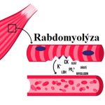 Rabdomyolýza (rhabdomyolýza) – příznaky, příčiny a léčba