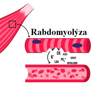 Rabdomyolýza je syndrom způsobený poraněním kosterního svalstva a zahrnuje únik velkého množství potenciálně toxického intracelulárního obsahu do plazmy.