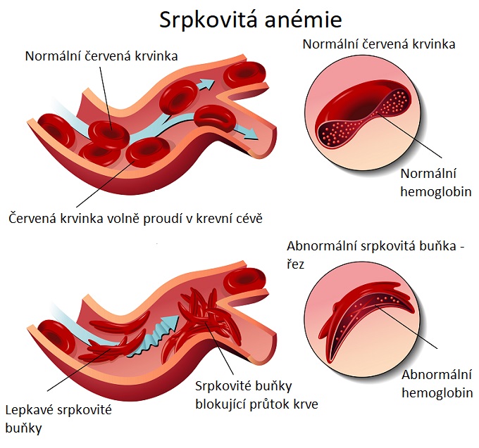 Srpkovitá anémie - ilustrace
