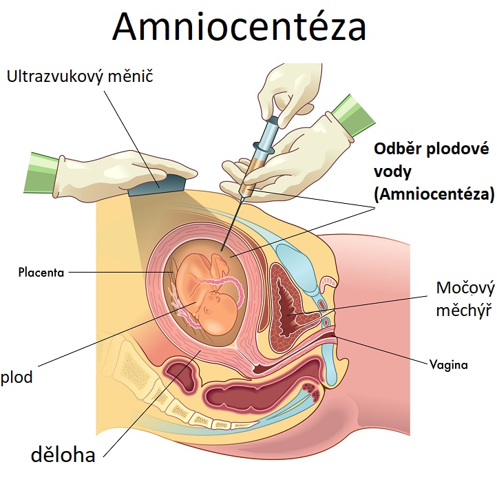 Amniocentéza - ilustrace