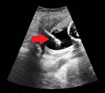 Při amniocentéze lékař vidí jehlu vedle plodu díky ultrazvuku.