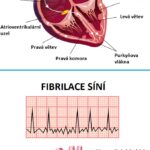 Jak vzniká fibrilace síní? A jak se léčí?