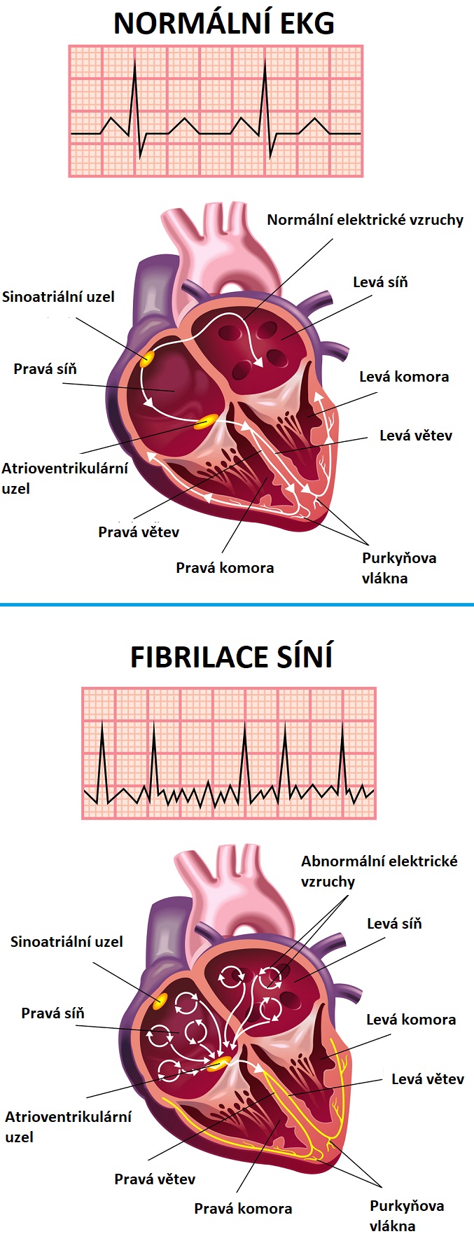 Fibrilace síní - ilustrace