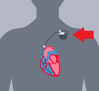Kardiostimulace & kardiostimulátory - jak fungují, a jak ovlivňují srdeční rytmus