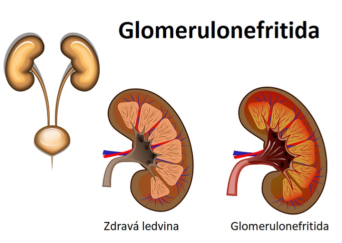 Glomerulonefritida - ilustrace