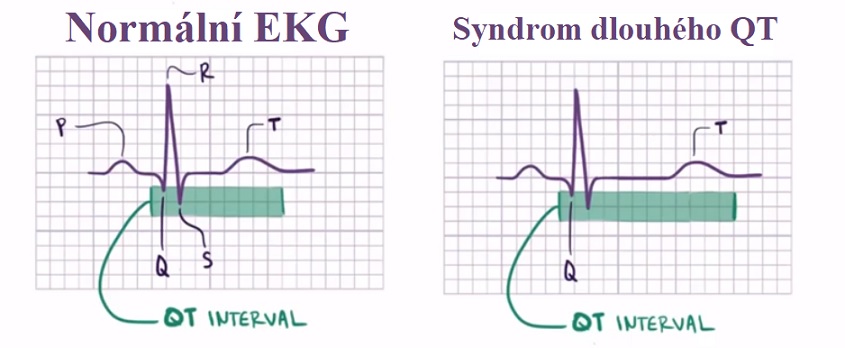 Porovnání na EKG