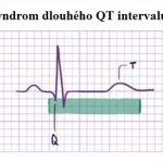 Syndrom dlouhého QT intervalu – co je to – příznaky, příčiny a léčba