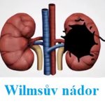 Wilmsův tumor (Wilmsův nádor, nefroblastom) – co je to – příznaky, příčiny a léčba