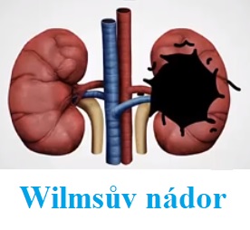 Wilmsův tumor (Wilmsův nádor, nefroblastom) - co je to - příznaky, příčiny a léčba