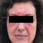 Dermatomyozitida – příznaky, příčiny a léčba