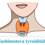 Hashimotova nemoc (Hashimotova tyroiditida, chronická lymfocytární tyreoiditida) – příznaky, příčiny a léčba