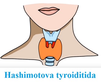 Hashimotova nemoc (Hashimotova tyroiditida) - příznaky, příčiny a léčba