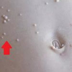 Jak na molusky (Molluscum Contagiosum)? Příznaky, příčiny a léčba