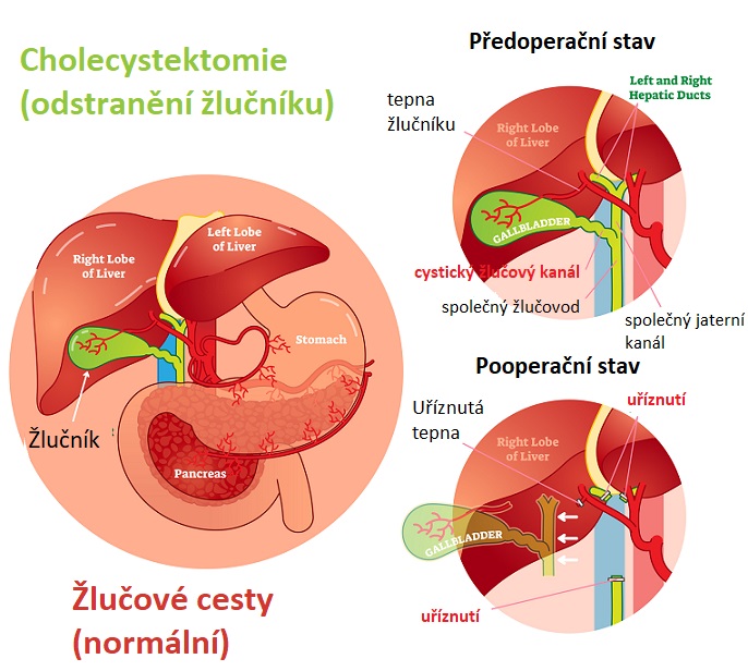 Cholecystektomie (odstranění žlučníku)  - ilustrace