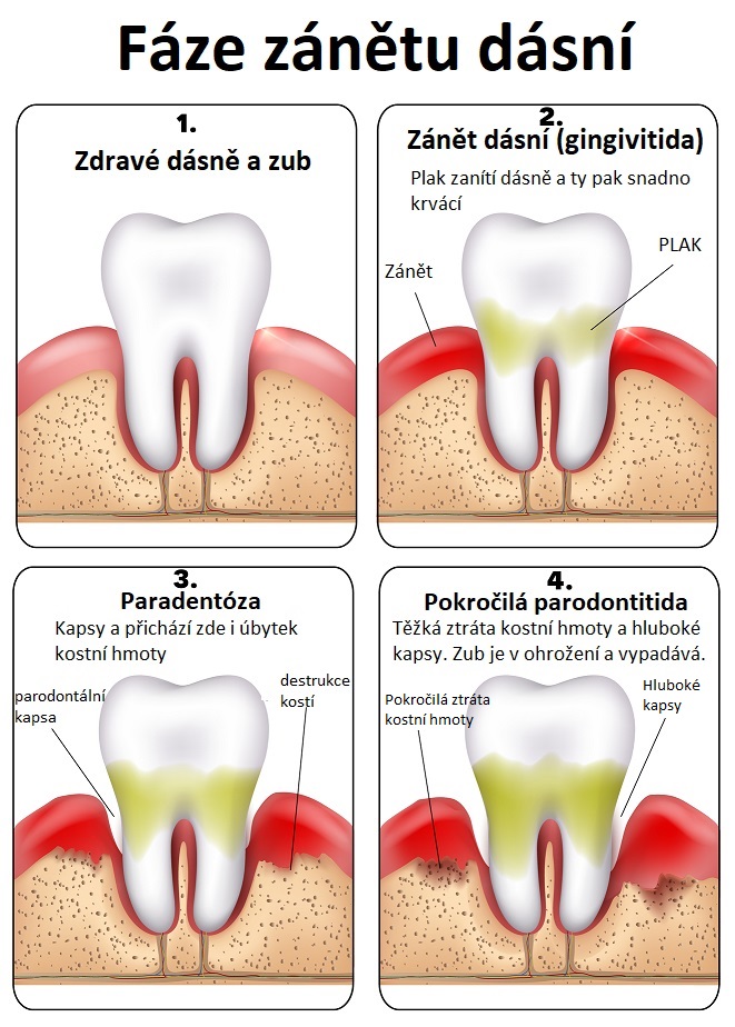 Neléčená gingivitida může způsobit oddělení dásní od zubů - ilustrace