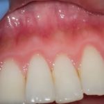 Zánět dásní (gingivitida) – příznaky, příčiny a léčba zánětu
