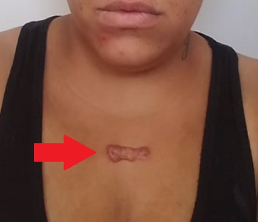 Keloidní jizvy - proč vznikají a jak se léčí?