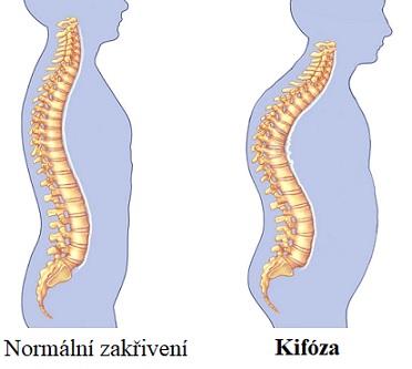 Máte kulatá záda? Pak možná trpíte kyfózou!