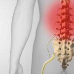 Lumbální spinální stenóza (zúžení páteře, stenóza páteře) – příznaky, příčiny a léčba