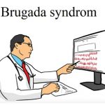 Brugada syndrom – co je to? Příznaky, příčiny a léčba