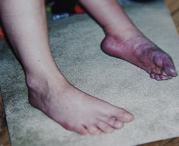 CRPS nejčastěji postihuje jednu z paží, nohu, ruku a obvykle se vyskytuje po zranění nebo traumatu končetiny.