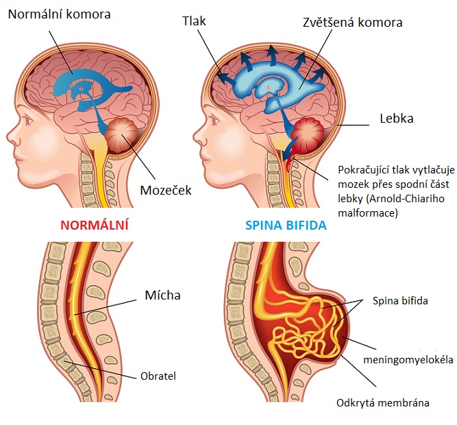 Spina bifida (rozštěp páteře) - ilustrace