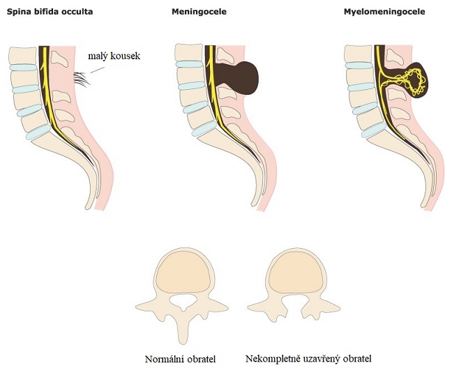 Typy spina bifida