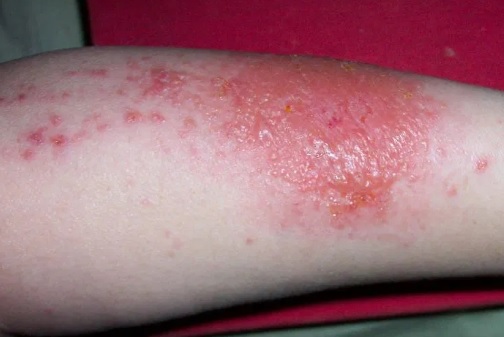 Dermatita: cauze, simptome, tratament