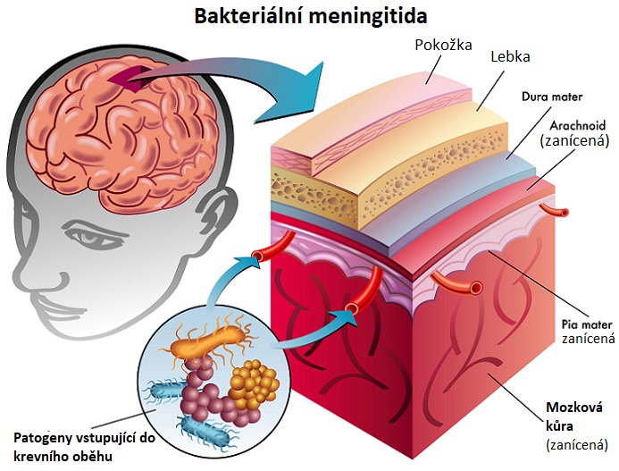 Bakteriální meningitida - ilustrace