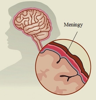 Meningitida postihuje meningy, membrány, které obklopují mozek a míchu.