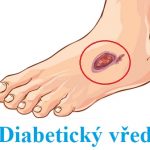 Syndrom diabetické nohy a vředy z cukrovky – co je to – příznaky, příčiny a léčba