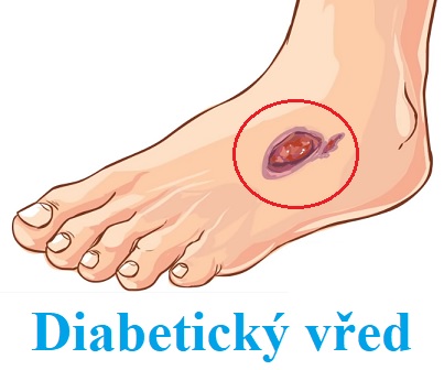 Vředy na nohou mohou být u diabetiků velkým problémem.