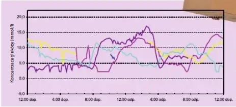 Obr. č. 2: Výrazné déletrvající hypoglykémie u dospívajícího chlapce v noci po stěhování nábytku. Bez monitorace by hypoglykémie nebyly vůbec zachyceny.