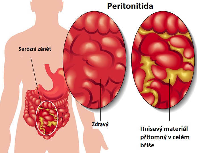 Peritonitida je zánět pobřišnice.