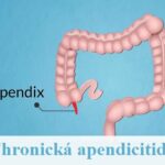 Chronický zánět slepého střeva (chronická apendicitida) – co je to – příznaky, příčiny a léčba