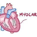 Myokarditida – zánět srdečního svalu – příznaky, příčiny a léčba