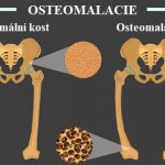 Osteomalacie – co to je – příznaky, příčiny a léčba