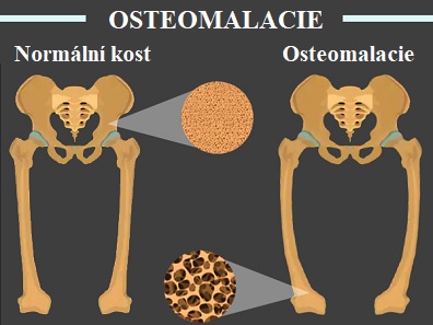 Osteomalacie - co to je - příznaky, příčiny a léčba | Rehabilitace ...