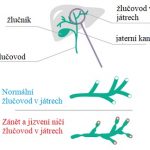 Primární biliární cirhóza – co to je – příznaky, příčiny a léčba