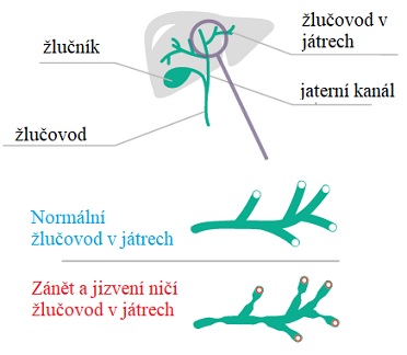 Primární biliární cirhóza - co to je - příznaky, příčiny a léčba