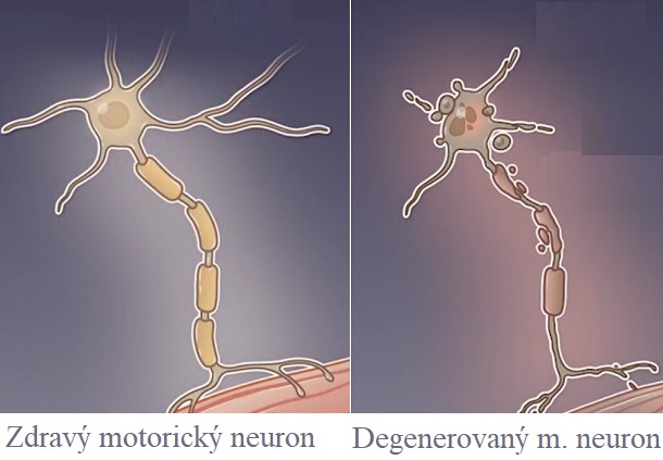 Spinální svalová atrofie (SMA) je závažné neurodegenerativní onemocnění charakterizované degenerací motorických neuronů v předních rozích míchy.