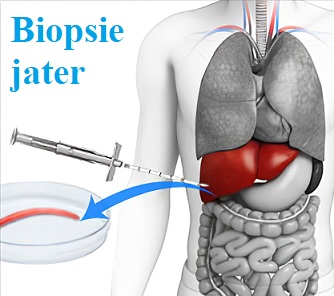 Biopsie jater je postup, při kterém se do jater vloží malá jehla, aby se odebral vzorek tkáně. Tkáň je poté analyzována v laboratoři, aby lékaři mohli diagnostikovat řadu poruch a onemocnění jater.