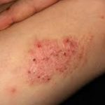 Neurodermatitida – co je to – příznaky, příčiny a léčba