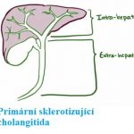 Primární sklerotizující cholangitida – co je to – příznaky, příčiny a léčba